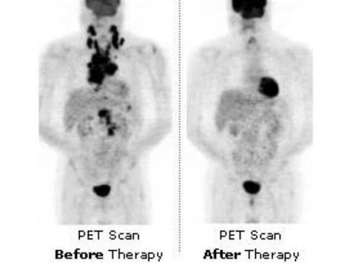 Do you feel bad after a PET scan?