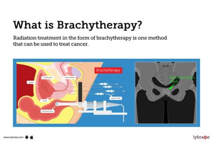 Do you have to stay in bed for brachytherapy?