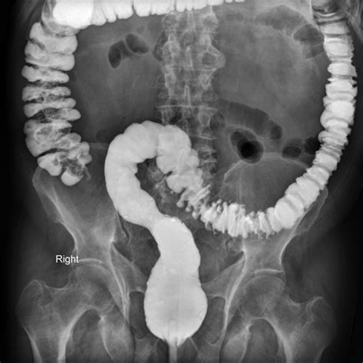 Does barium affect MRI?