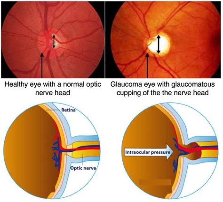 Does body weight affect intraocular pressure?