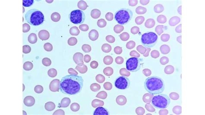 Does CLL affect the skin?