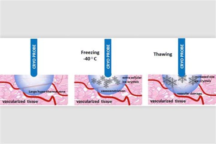 Does cryotherapy destroy the prostate?