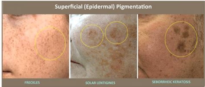 Does dermal hyperpigmentation fade?