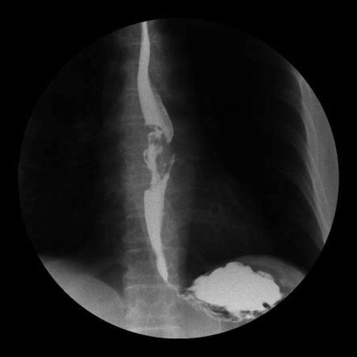 Does esophageal cancer show up on barium swallow?