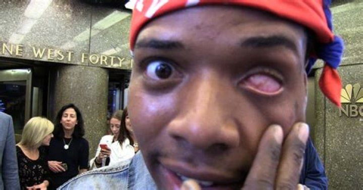 Does Fetty Wap have a prosthetic eye?