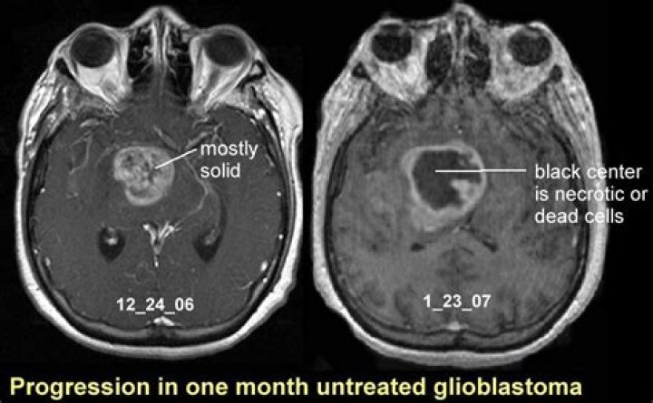 Does glioblastoma cause swelling?