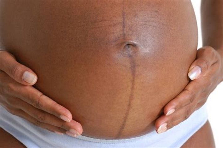 Does linea nigra appear in early pregnancy?