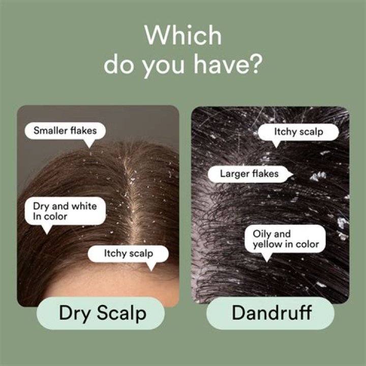 Does long hair cause more dandruff?