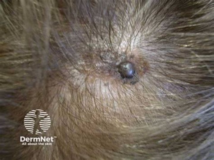 Does Melanoma give you headaches?