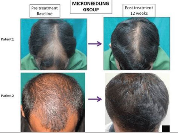 Does micro needling help hair growth?