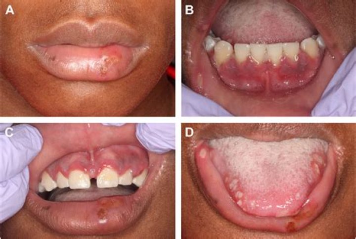 Does oral herpes appear immediately?