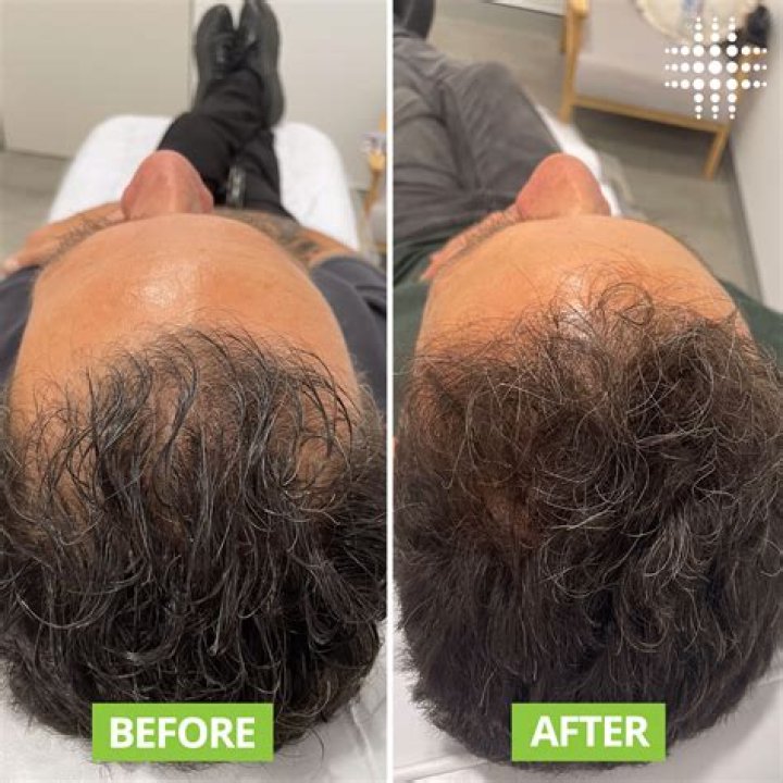 Does selenium regrow hair?