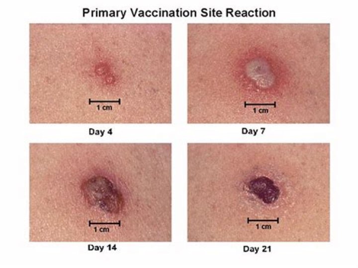 Does smallpox vaccine have live virus?