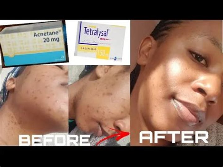 Does Tetralysal work for acne?
