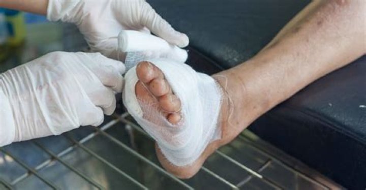 Does wound dressing promote exudate?