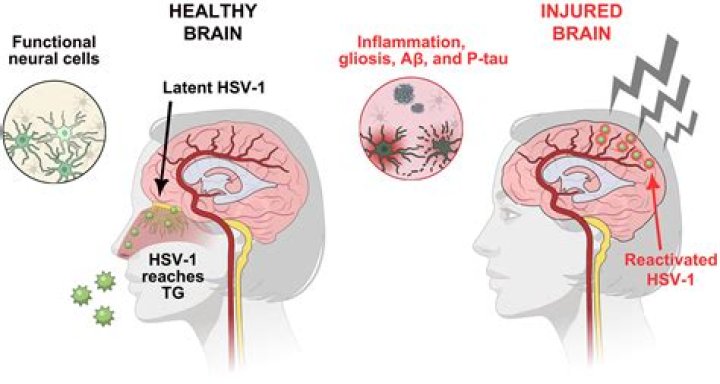 Has hsv1 ever been cured?