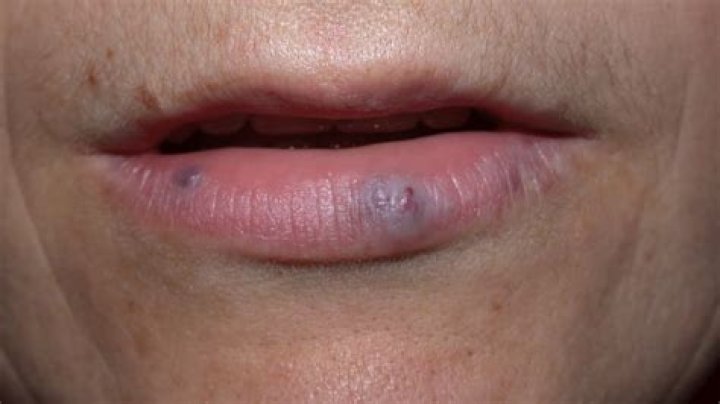 How can I get rid of dark spots on my lips?
