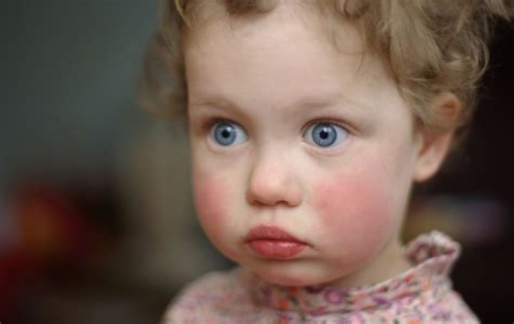 How contagious is slapped cheek?