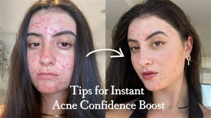 How do I become self confident with acne?