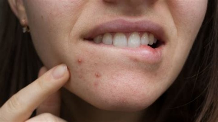 How do I get rid of a red spot on my lip?