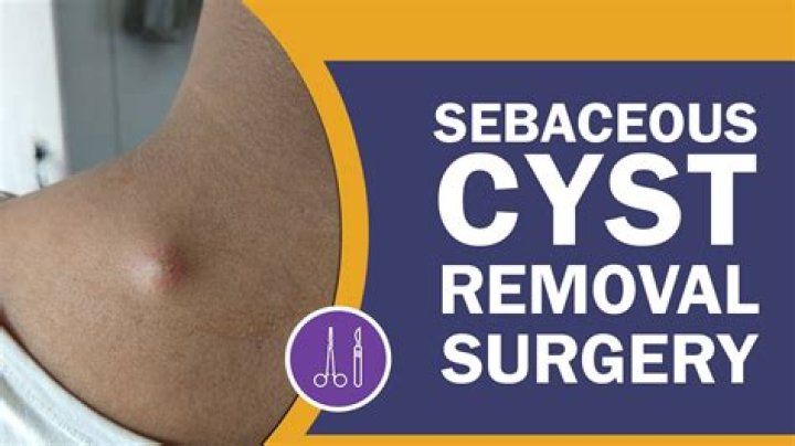 How do I get rid of a sebaceous cyst on my labia?