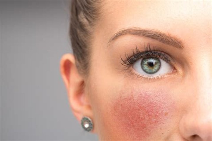 How do I get rid of redness on my face?