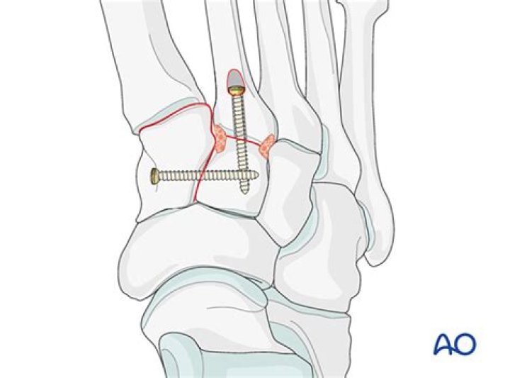 How do I know if I have a Lisfranc fracture?