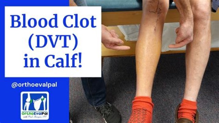 How do I know if I have DVT in my calf?