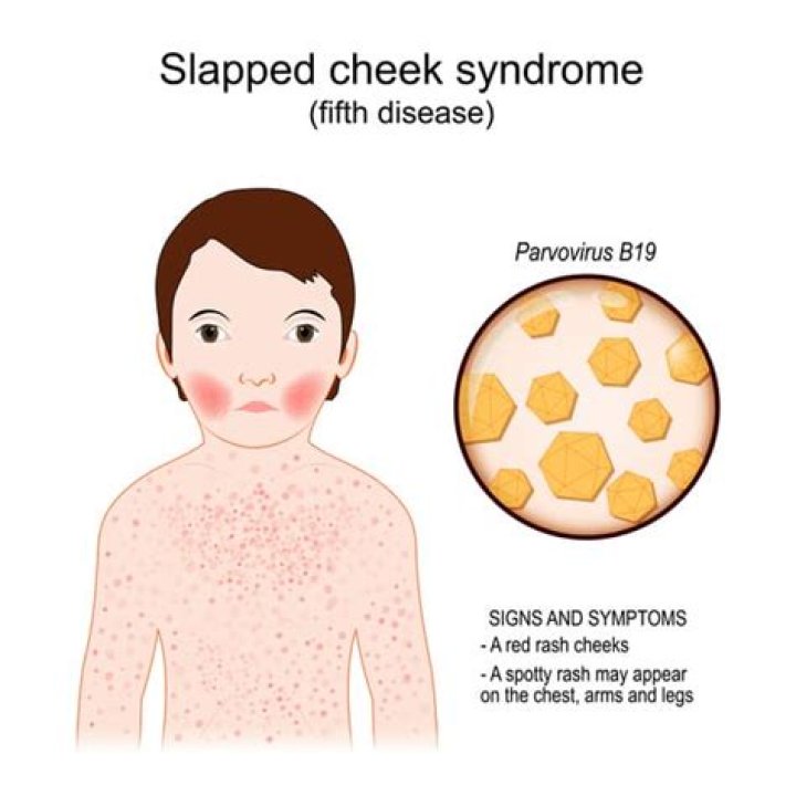 How do I know if my child has Fifths disease?