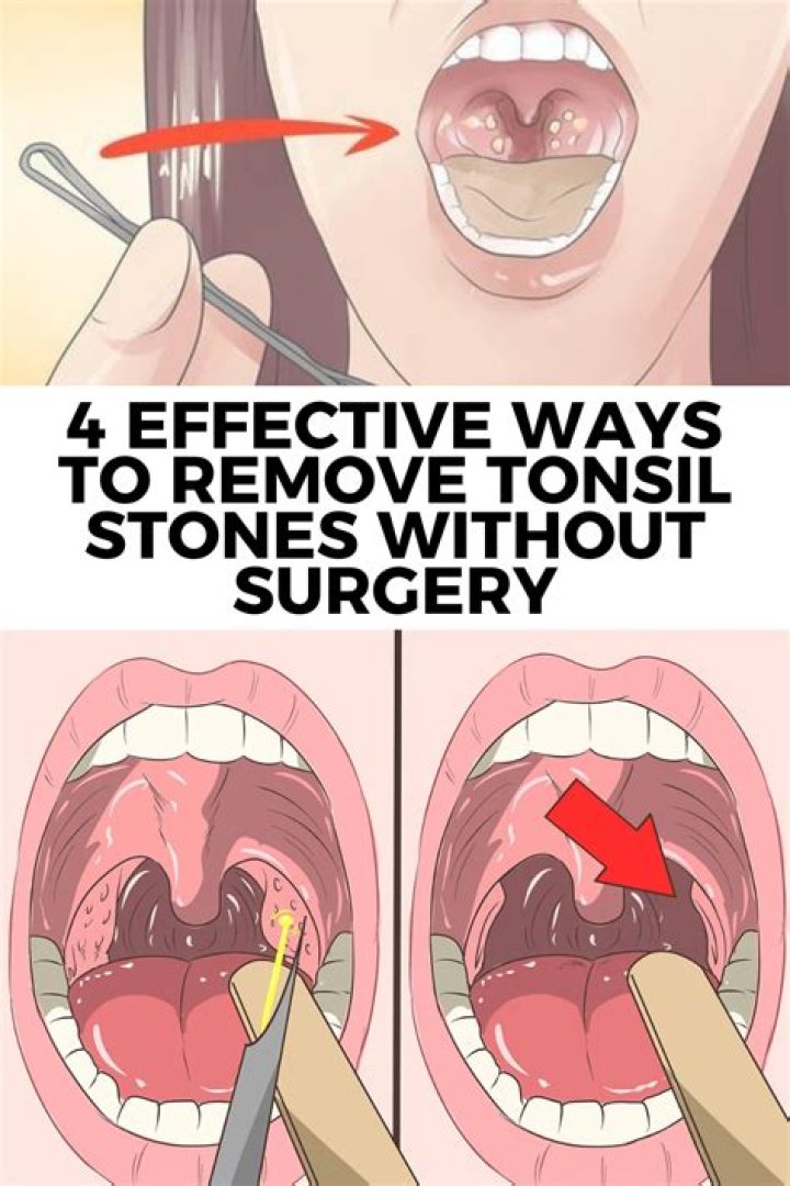 How do professionals remove tonsil stones?