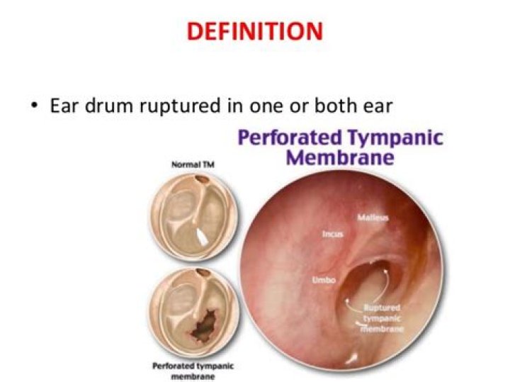 How do you describe the tympanic membrane perforation?