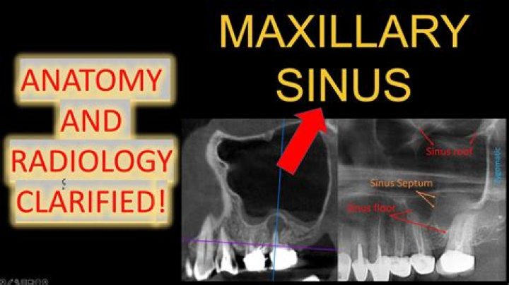 How do you evaluate maxillary sinuses?
