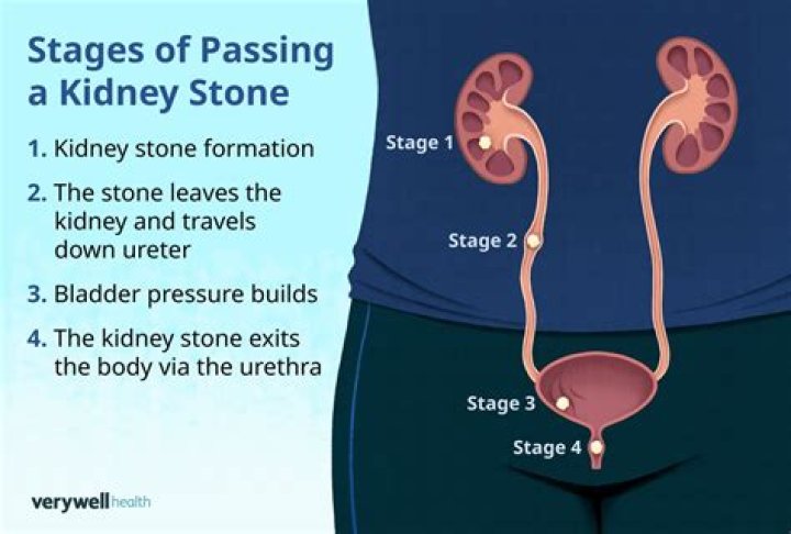 How do you get a stuck stone out of your urinary tract?
