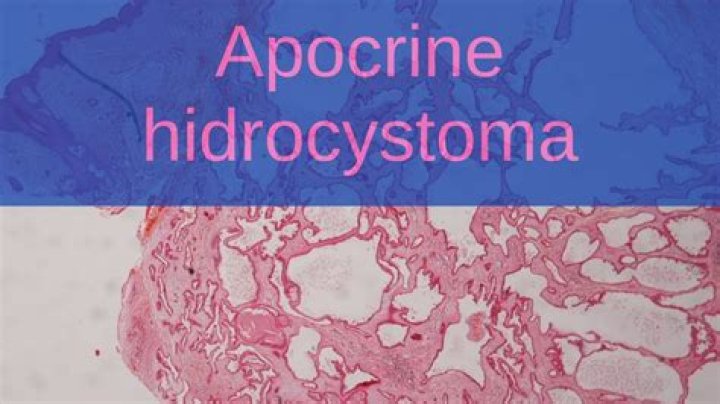 How do you get rid of apocrine Hidrocystoma?