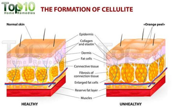 How do you get rid of cellulite in 2020?