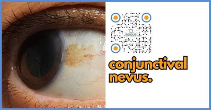 How do you get rid of conjunctival melanosis?
