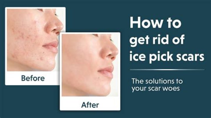 How do you get rid of ice pick scars on your nose?