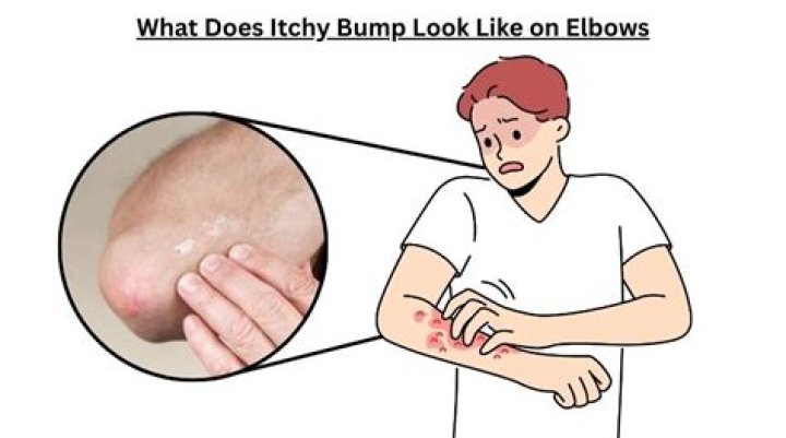 How do you get rid of little bumps on your elbows?