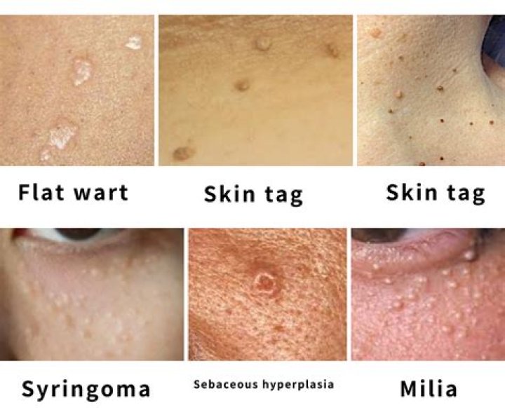 How do you get rid of Syringoma bumps?