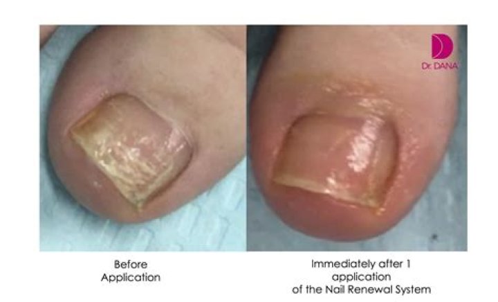 How do you get rid of toenail discoloration from nail polish?