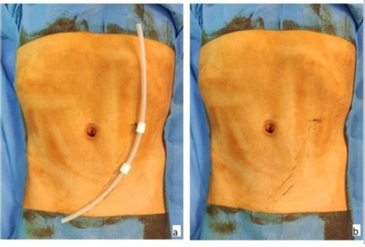 How do you insert a peritoneal dialysis catheter?