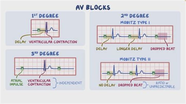 How do you know if you have 2nd degree AV block type 2?