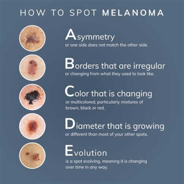 How do you know if you have melanoma on face?