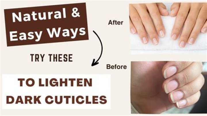 How do you treat dark cuticles?
