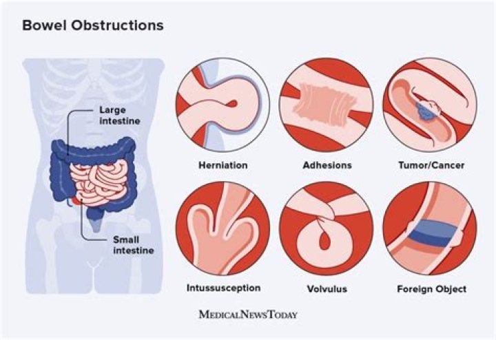 How do you treat intestinal lymphoma?
