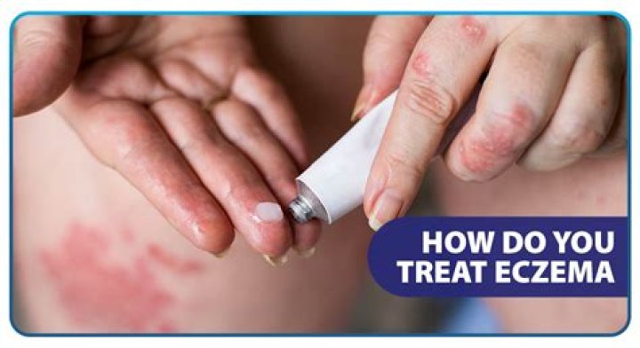 How do you treat papular eczema?