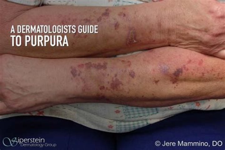 How do you treat Purpuric dermatosis?