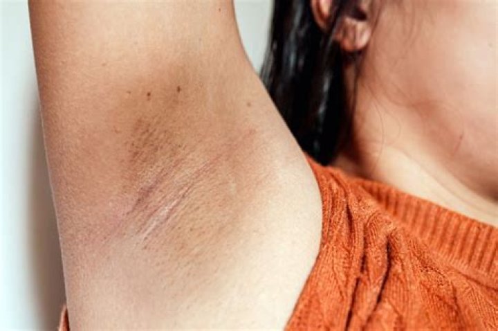 How do you treat underarm fungal rash?