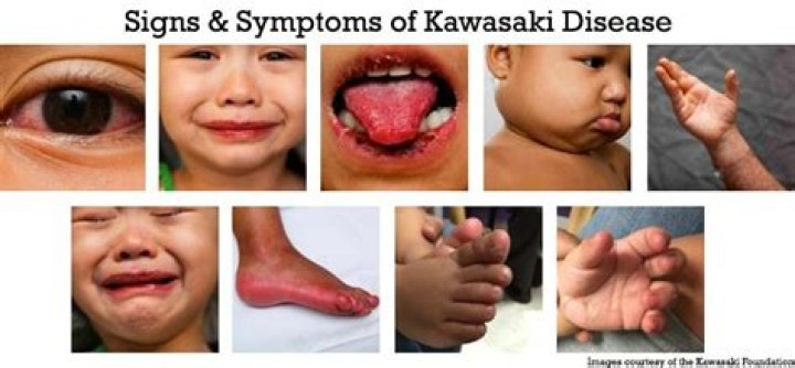 How does someone get Kawasaki disease?