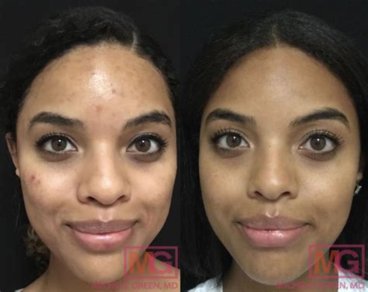 How effective is Accutane for cystic acne?
